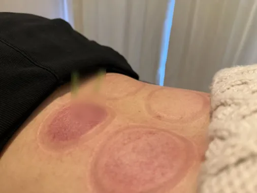 スペシャル美容鍼＆体質改善